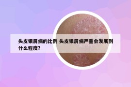 頭皮銀屑病的比例 頭皮銀屑病嚴(yán)重會發(fā)展到什么程度?