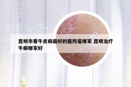 昆明市看牛皮癬最好的醫(yī)院是哪家 昆明治療牛癬哪家好