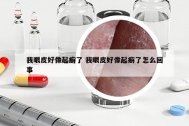 我眼皮好像起癬了 我眼皮好像起癬了怎么回事