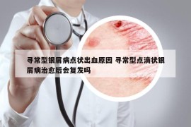 尋常型銀屑病點狀出血原因 尋常型點滴狀銀屑病治愈后會復(fù)發(fā)嗎