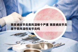 銀屑病關(guān)節(jié)炎類風(fēng)濕哪個嚴(yán)重 銀屑病關(guān)節(jié)炎屬于類風(fēng)濕性關(guān)節(jié)炎嗎