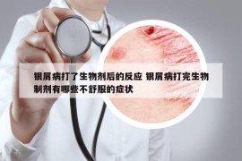 銀屑病打了生物劑后的反應(yīng) 銀屑病打完生物制劑有哪些不舒服的癥狀