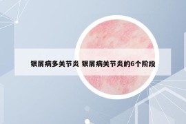 銀屑病多關(guān)節(jié)炎 銀屑病關(guān)節(jié)炎的6個(gè)階段