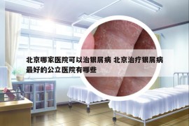北京哪家醫(yī)院可以治銀屑病 北京治療銀屑病最好的公立醫(yī)院有哪些
