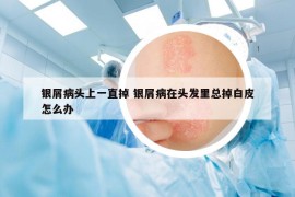 銀屑病頭上一直掉 銀屑病在頭發(fā)里總掉白皮怎么辦
