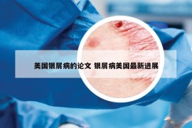 美國銀屑病的論文 銀屑病美國最新進展