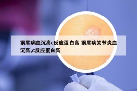 銀屑病血沉高c反應(yīng)蛋白高 銀屑病關(guān)節(jié)炎血沉高,c反應(yīng)蛋白高