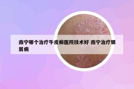 南寧哪個治療牛皮癬醫(yī)院技術(shù)好 南寧治療銀屑病