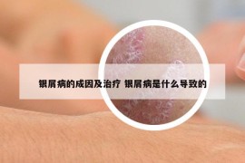 銀屑病的成因及治療 銀屑病是什么導(dǎo)致的