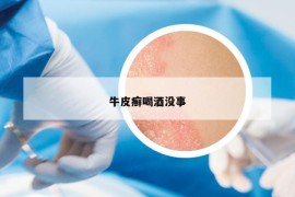 牛皮癬喝酒沒事