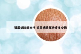 銀屑病臉部治療 銀屑病臉部治療多少錢