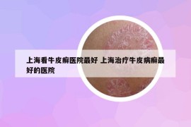 上海看牛皮癬醫(yī)院最好 上海治療牛皮病癬最好的醫(yī)院
