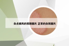 白點癲風(fēng)的初期圖片 正常的白斑圖片