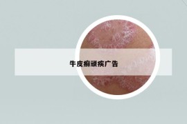 牛皮癬頑疾廣告