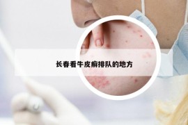 長春看牛皮癬排隊(duì)的地方