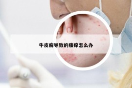 牛皮癬導(dǎo)致的瘙癢怎么辦