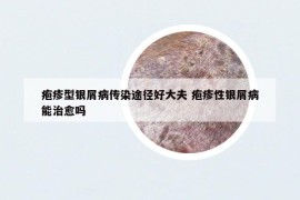 皰疹型銀屑病傳染途徑好大夫 皰疹性銀屑病能治愈嗎