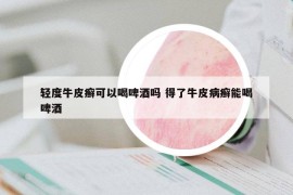 輕度牛皮癬可以喝啤酒嗎 得了牛皮病癬能喝啤酒