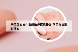 華佗怎么治牛皮癬治療醫(yī)院排名 華佗治皮膚科神方