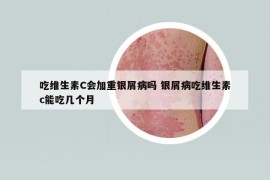 吃維生素C會加重銀屑病嗎 銀屑病吃維生素c能吃幾個月