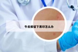 牛皮癬留下黑印怎么辦