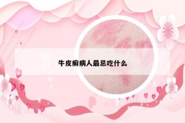 牛皮癬病人最忌吃什么