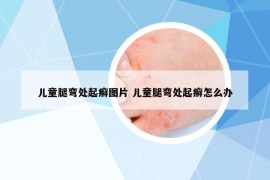 兒童腿彎處起癬圖片 兒童腿彎處起癬怎么辦
