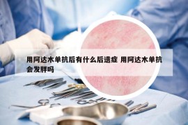 用阿達(dá)木單抗后有什么后遺癥 用阿達(dá)木單抗會(huì)發(fā)胖嗎