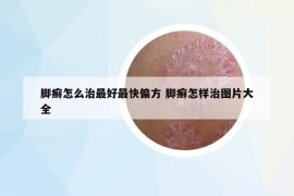 腳癬怎么治最好最快偏方 腳癬怎樣治圖片大全