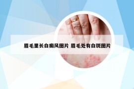眉毛里長(zhǎng)白癜風(fēng)圖片 眉毛處有白斑圖片