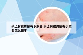 頭上有銀屑病有小膿包 頭上有銀屑病有小膿包怎么回事
