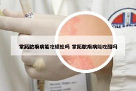 掌跖膿皰病能吃蜈蚣嗎 掌跖膿皰病能吃醋嗎