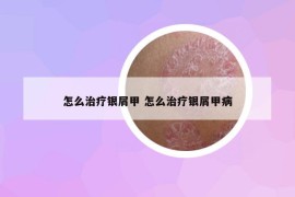 怎么治療銀屑甲 怎么治療銀屑甲病
