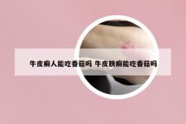 牛皮癬人能吃香菇嗎 牛皮膚癬能吃香菇嗎