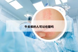 牛皮癬的人可以吃醋嗎