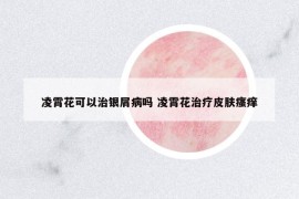 凌霄花可以治銀屑病嗎 凌霄花治療皮膚瘙癢