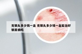 克銀丸多少錢一盒 克銀丸多少錢一盒能治好銀屑病嗎