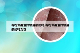 有吃生姜治好銀屑病的嗎 有吃生姜治好銀屑病的嗎女性