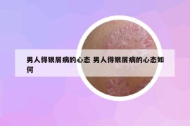 男人得銀屑病的心態(tài) 男人得銀屑病的心態(tài)如何