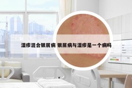 濕疹混合銀屑病 銀屑病與濕疹是一個(gè)病嗎