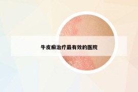 牛皮癬治療最有效的醫(yī)院