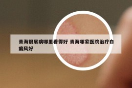 青海銀屑病哪里看得好 青海哪家醫(yī)院治療白癜風(fēng)好