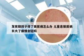 發(fā)育期孩子得了銀屑病怎么辦 兒童患銀屑病長大了病情會輕嗎