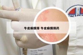 牛皮癬摸得 牛皮癬摸得藥