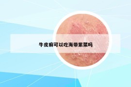 牛皮癬可以吃海帶紫菜嗎