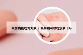 銀屑病能吃青大蘿卜 銀屑病可以吃水蘿卜嗎