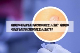 扁桃體引起的點(diǎn)滴狀銀屑病怎么治療 扁桃體引起的點(diǎn)滴狀銀屑病怎么治療好
