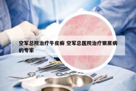 空軍總院治療牛皮癬 空軍總醫(yī)院治療銀屑病的專家
