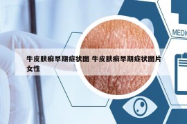 牛皮膚癬早期癥狀圖 牛皮膚癬早期癥狀圖片女性