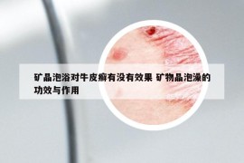 礦晶泡浴對牛皮癬有沒有效果 礦物晶泡澡的功效與作用
